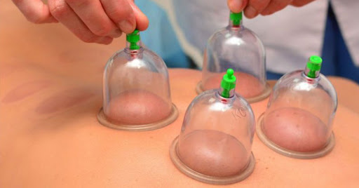 Investigating Cupping Treatment in Lindenhurst: A Comprehensive Accomplice